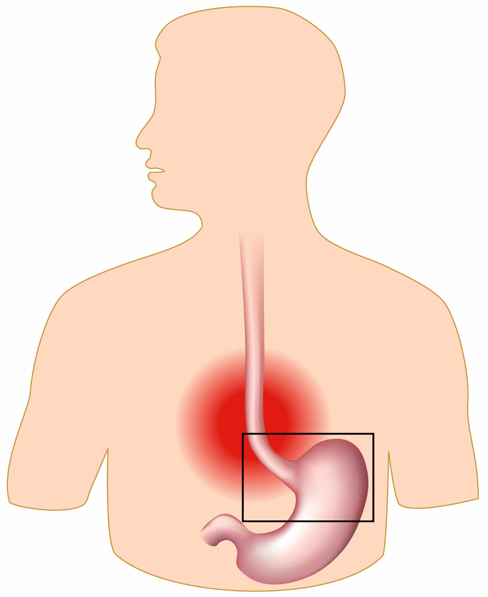 Indigestion: excess or deficiency of stomach acid?